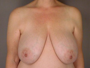 Breast Reduction