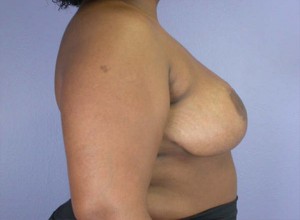 Breast Reduction