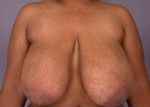 Breast Reduction