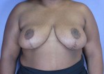 Breast Reduction