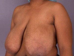 Breast Reduction