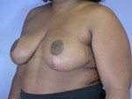 Breast Reduction