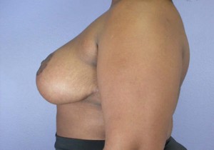 Breast Reduction