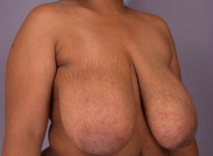 Breast Reduction