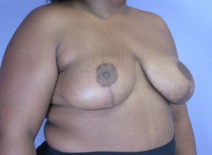 Breast Reduction