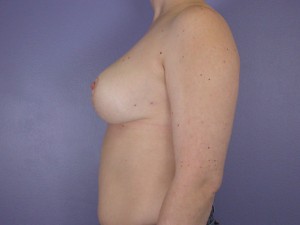 Breast Reduction