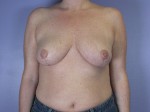 Breast Reduction