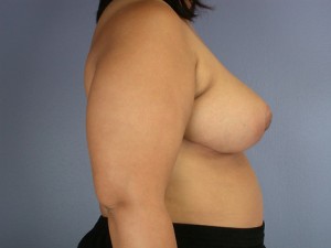 Breast Reduction