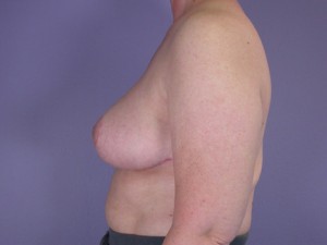 Breast Reduction