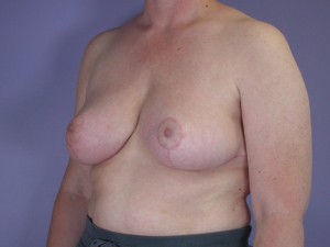 Breast Reduction