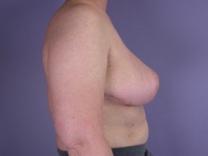 Breast Reduction