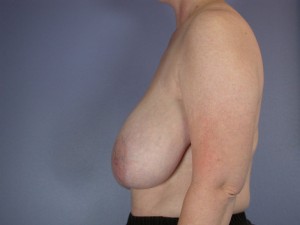 Breast Reduction