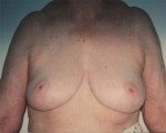 Breast Reduction