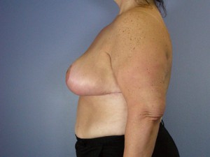 Breast Reduction