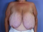 Breast Reduction