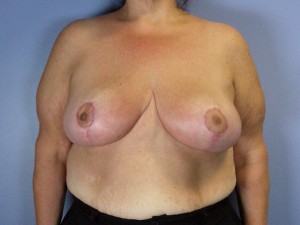 Breast Reduction