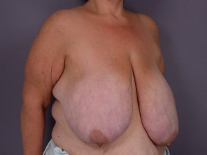 Breast Reduction