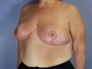 Breast Reduction