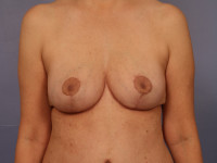 Breast Reduction