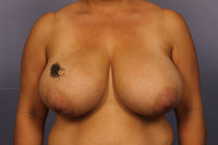 Breast Reduction